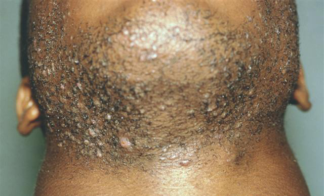 Best Men's Ingrown Hairs Treatment